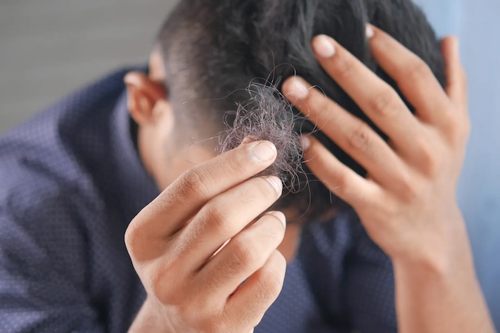 Dầu gội trị hói đầu rụng tóc