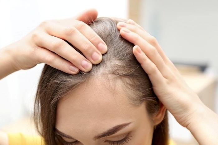 Dấu hiệu bị hói đầu