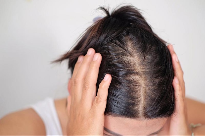 Dấu hiệu của bệnh hói Dấu hiệu của bệnh hói