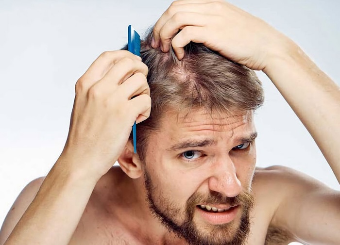 Dấu hiệu hói đầu ở nam