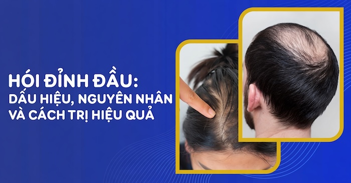 Dấu hiệu hói đỉnh đầu