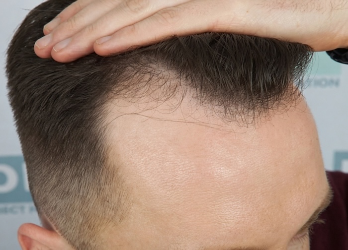 Dấu hiệu hói trán