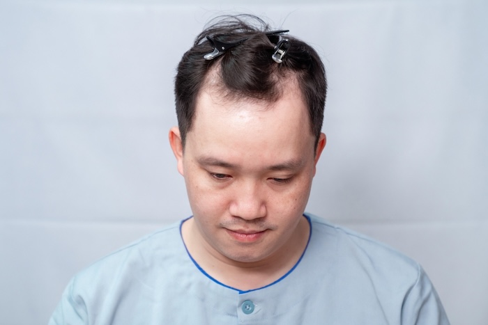 Đầu hói chữ m