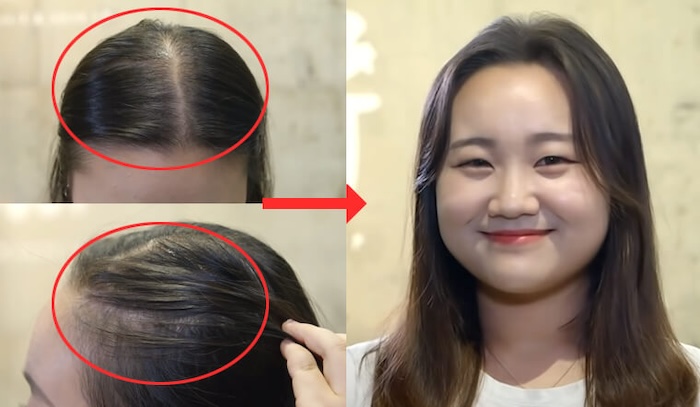 Để tóc 2 mái có bị hói không