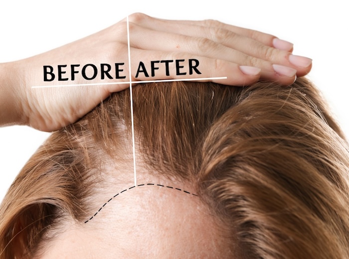 Đi cấy tóc hết bao nhiêu tiền