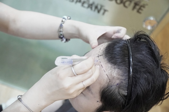 Dịch vụ cấy tóc giá