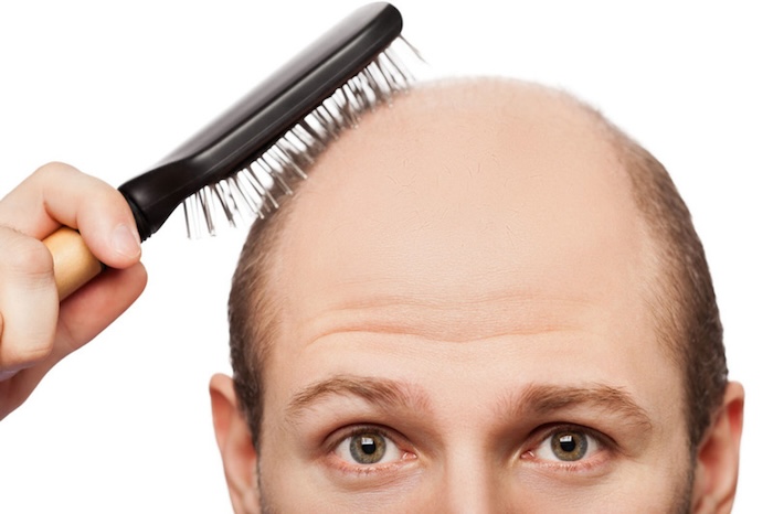 Đỉnh đầu bị hói