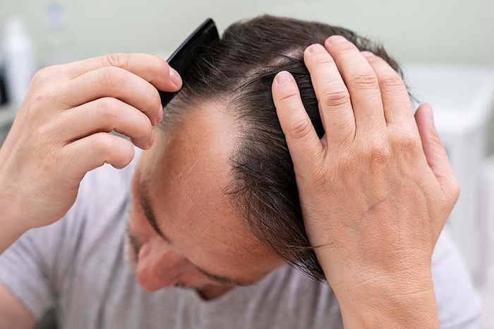Giá cấy tóc sinh học