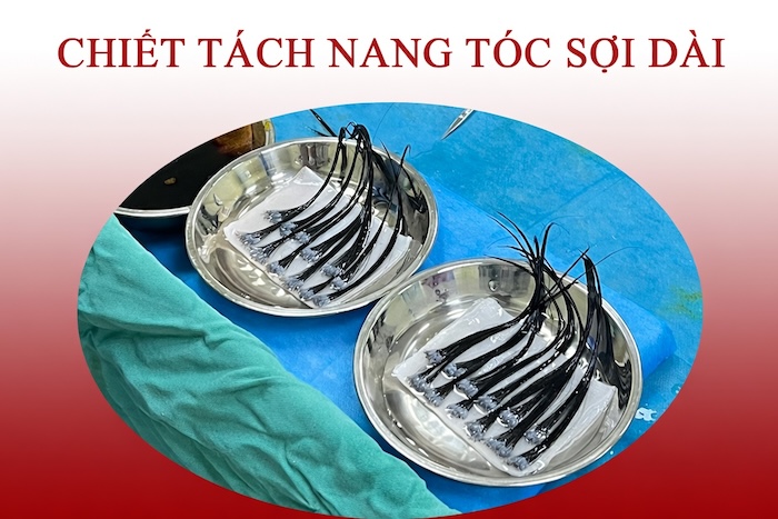 Giá cấy tóc sợi dài
