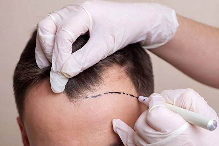 Giá cấy tóc trán chữ m