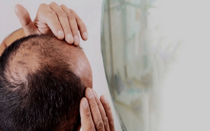 Giá cấy tóc tự thân