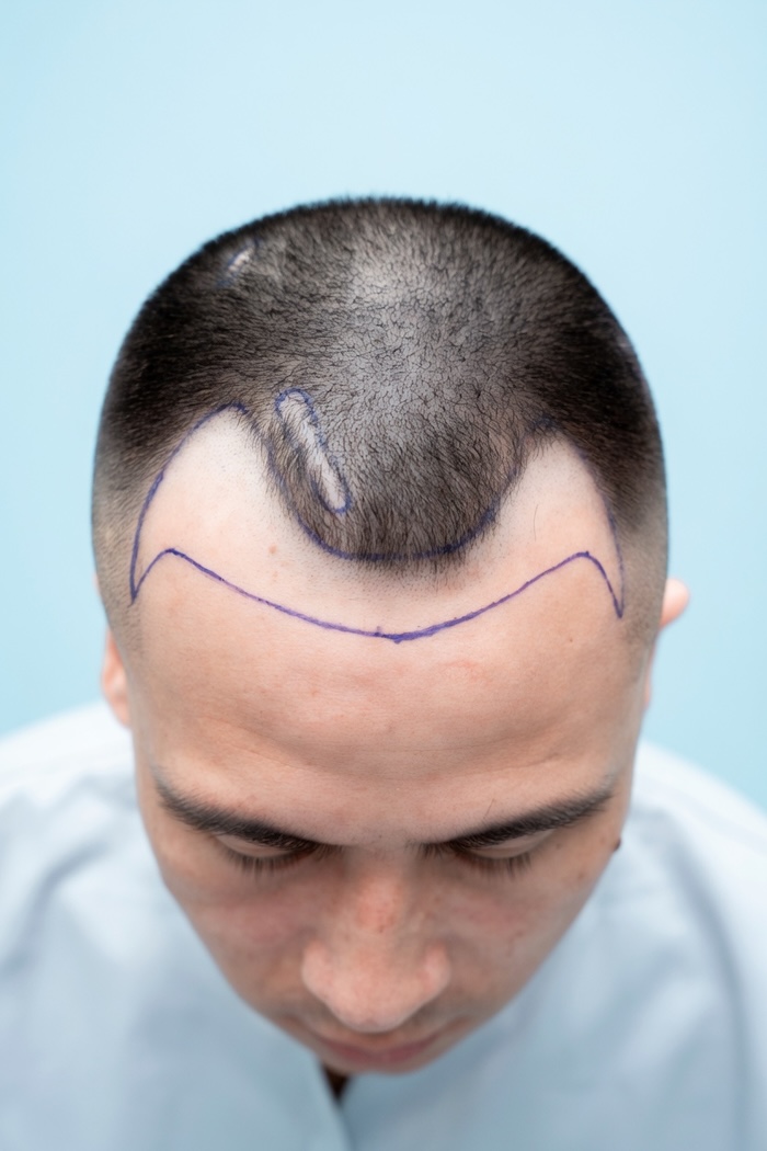Hói chữ m