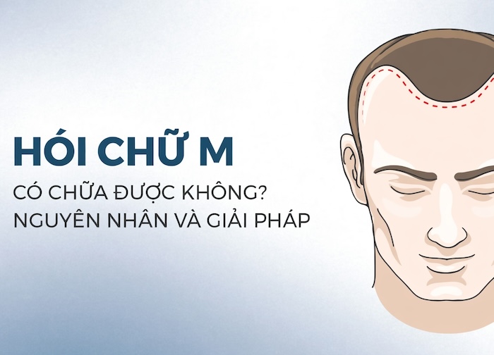 Hói chữ m có chữa được không