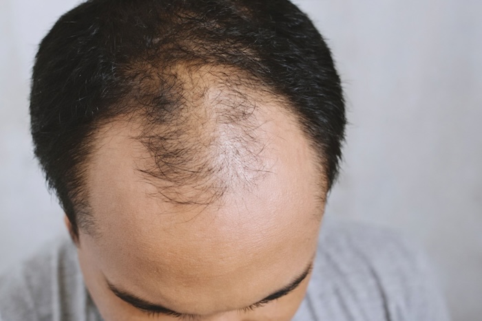 Hói chữ m là gì