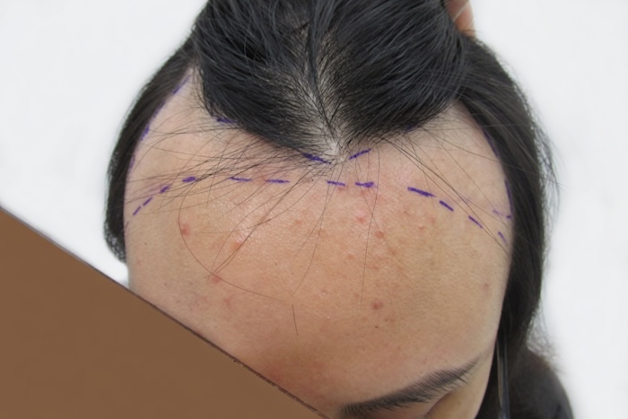 Hói chữ m ở nữ