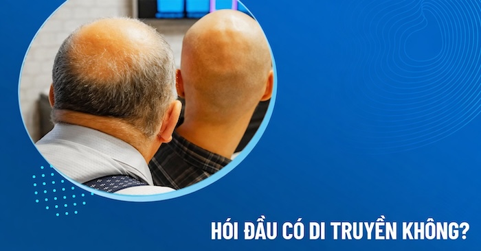 Hói có di truyền không