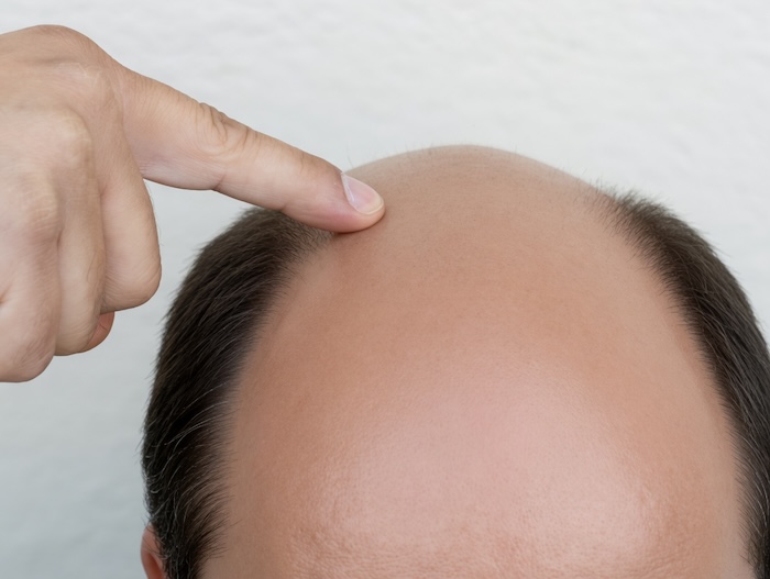 Hói đầu bẩm sinh