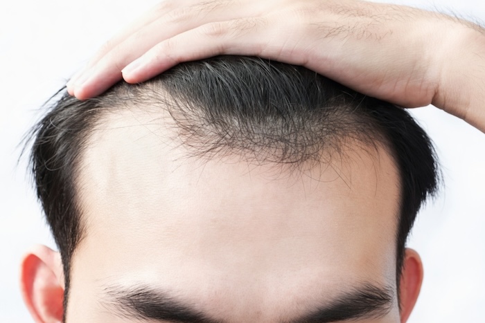 Hói đầu chữ m