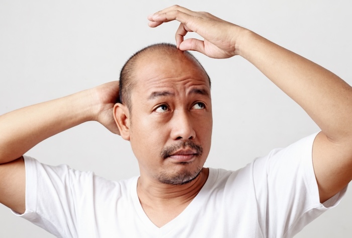 hói đầu có bị vô sinh không