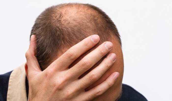 Hói đầu có chữa được không