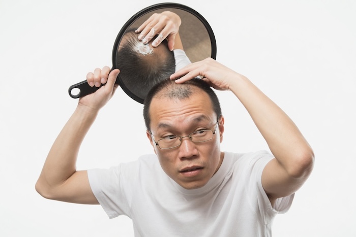 Hói đầu di truyền có chữa được không