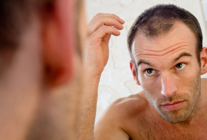 Hói đầu do di truyền có chữa được không
