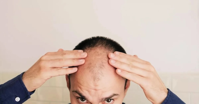 Hói đầu do gen