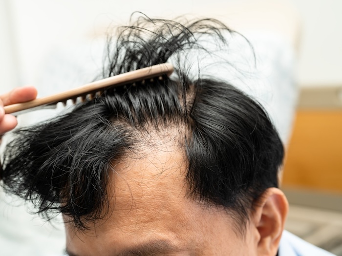Hói đầu do gì