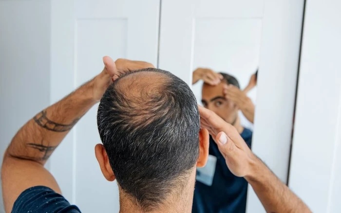 Hói đầu do nhuộm tóc Hói đầu do nhuộm tóc