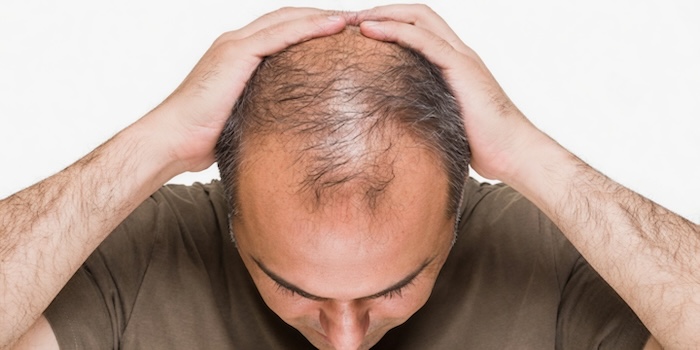 Hói đầu hình chữ m Hói đầu hình chữ m