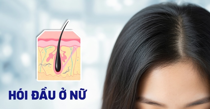 Hói đầu nữ