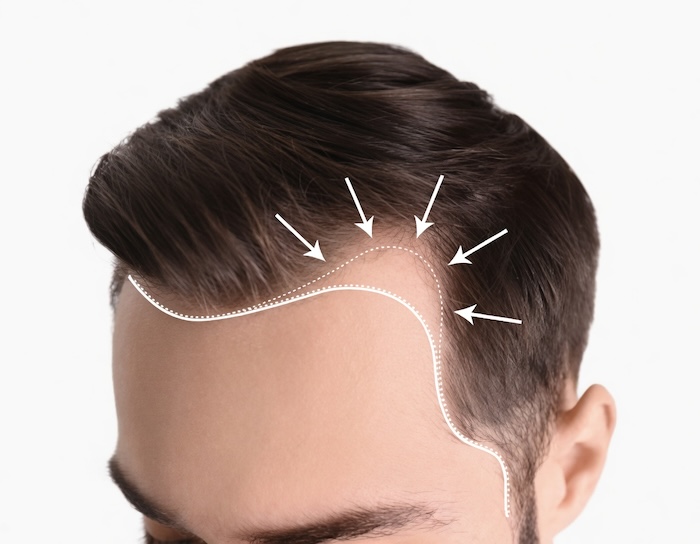 Hói đầu ở nam giới