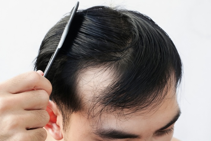 Hói đầu ở nam giới có chữa được không Hói đầu ở nam giới có chữa được không