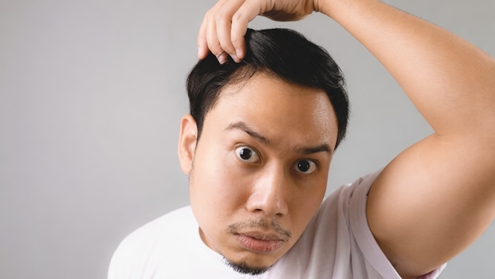 Hói đầu và cách khắc phục