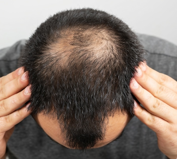 Hói đỉnh đầu nam