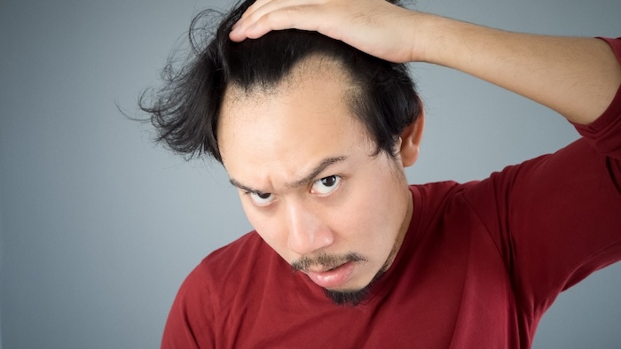 Hói nửa đầu