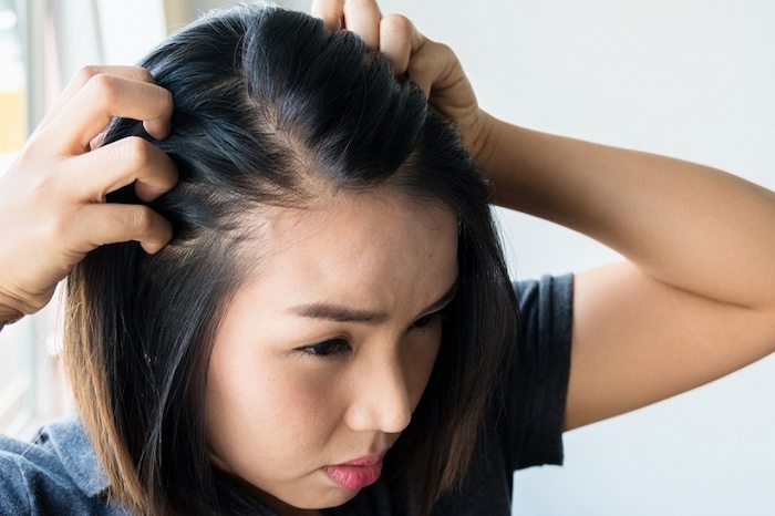 Hói trán ở nữ