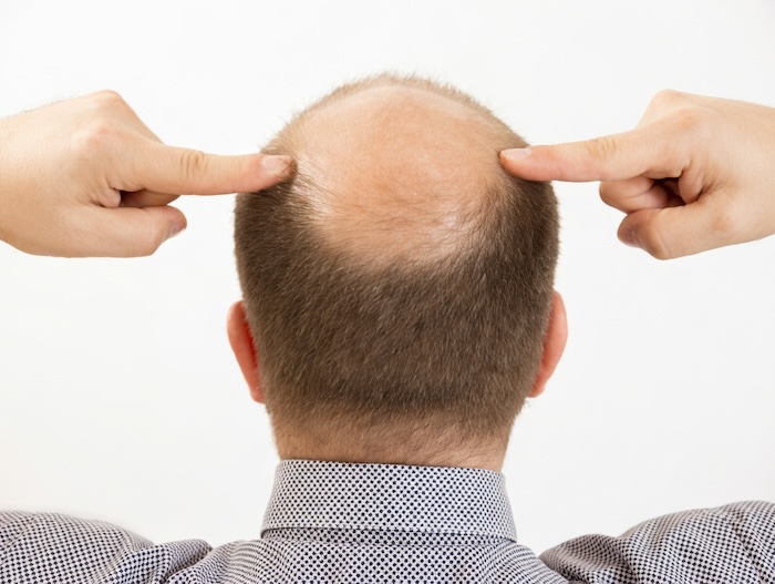 Hói trên đỉnh đầu