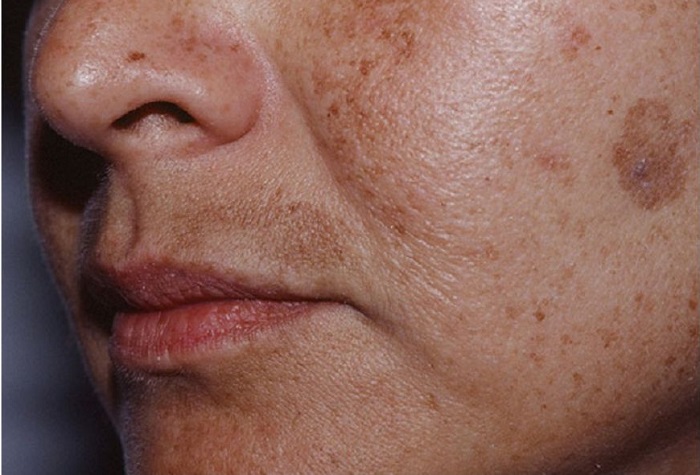 Khắc phục nám râu