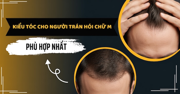 Kiểu tóc cho đầu hói chữ m