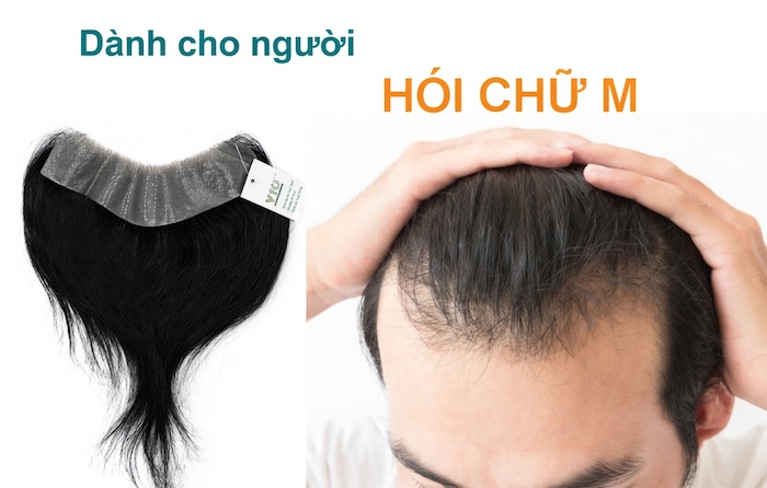 Kiểu tóc cho người hói chữ m nam