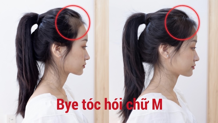 Kiểu tóc cho người hói chữ m nữ