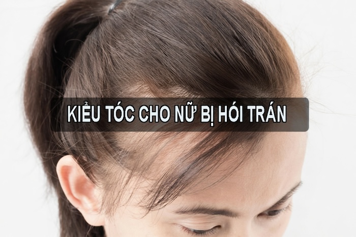 Kiểu tóc cho nữ bị hói trán