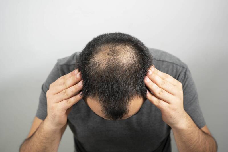 Lý do bị hói