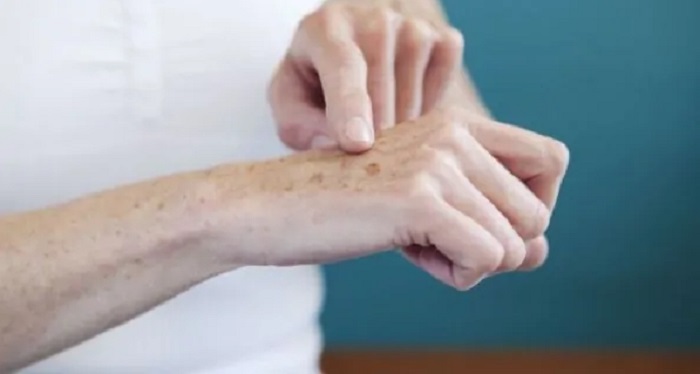 Mu bàn tay bị nám đen