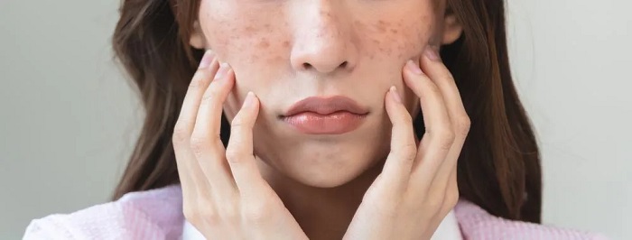 Nám chân sâu nằm ở lớp nào của da