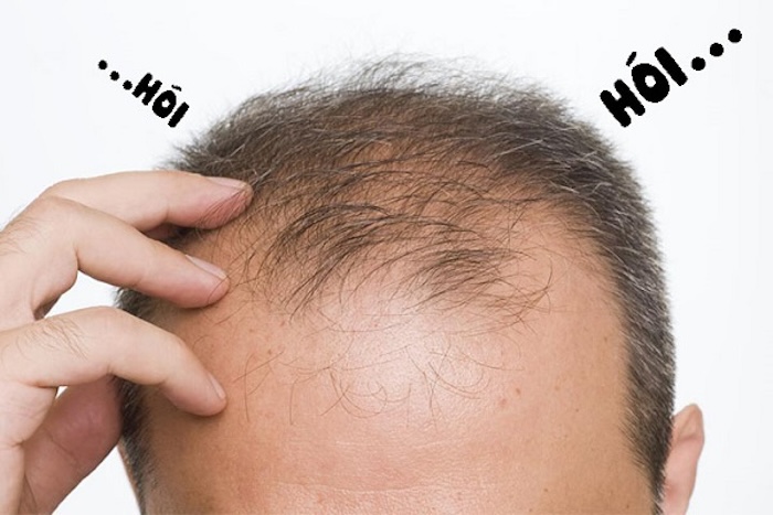 Nguyên nhân gây hói đầu nam giới Nguyên nhân gây hói đầu nam giới