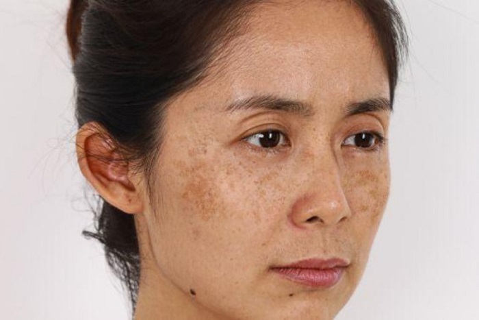 Nguyên nhân gây nám sạm da