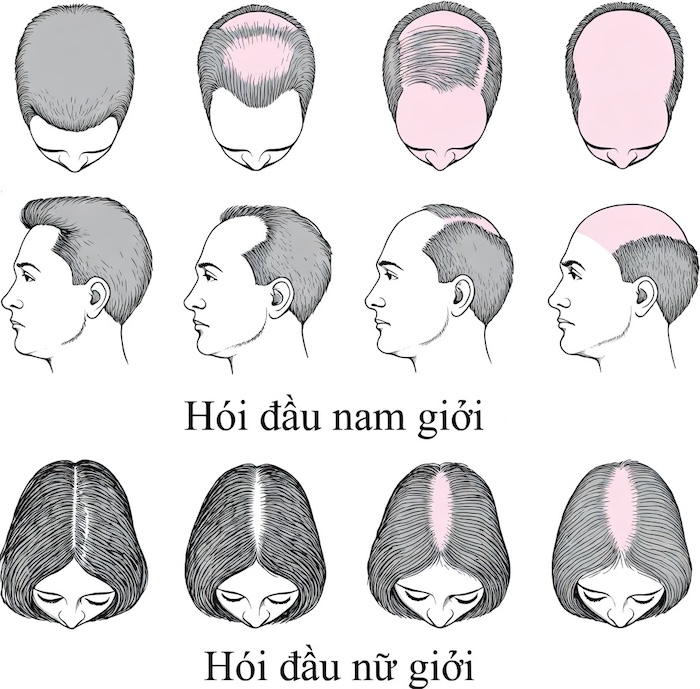 Nguyên nhân hói đầu