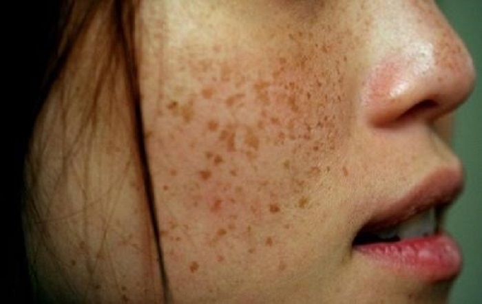 Những dấu hiệu bị nám Những dấu hiệu bị nám